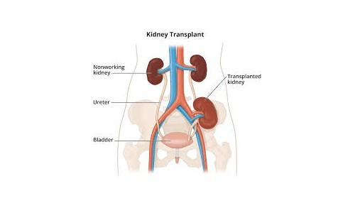 Kidney Transplant